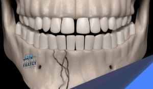 روش های تشخیص شکستگی فک