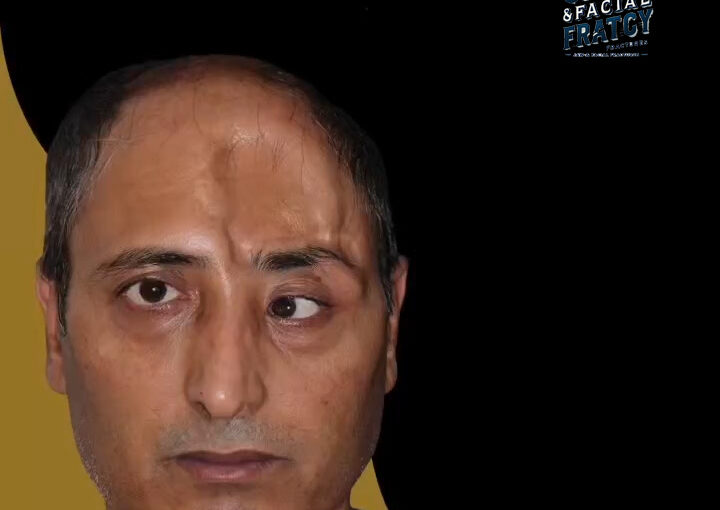 تغییر شکل صورت بعد از شکستگی فک