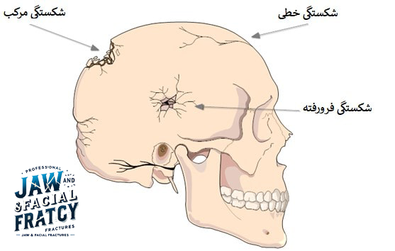 شکستگی کاسه سر