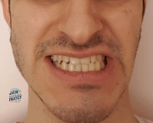 عوارض درمان نکردن فک شکسته