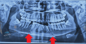 نقش MRI در تشخیص شکستگی فک