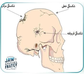 شکستگی مرکب کاسه سر