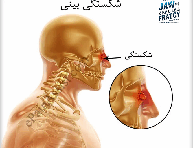 تشخیص شکستگی بینی