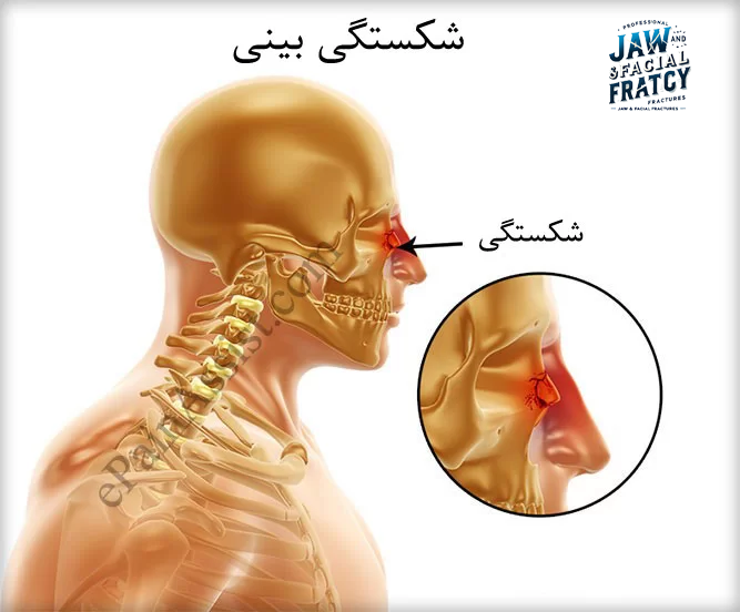 تشخیص شکستگی بینی