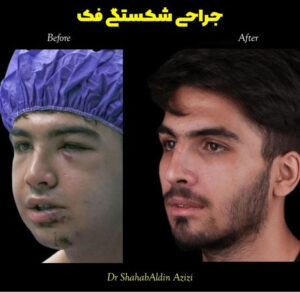 درمان شکستگی گونه