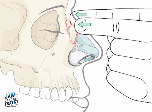 ارتباط شکستگی بینی با مشکلات تنفسی