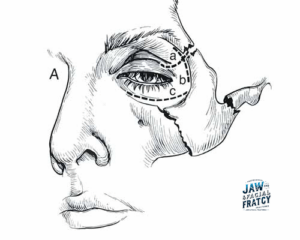 تشخیص شکستگی گونه