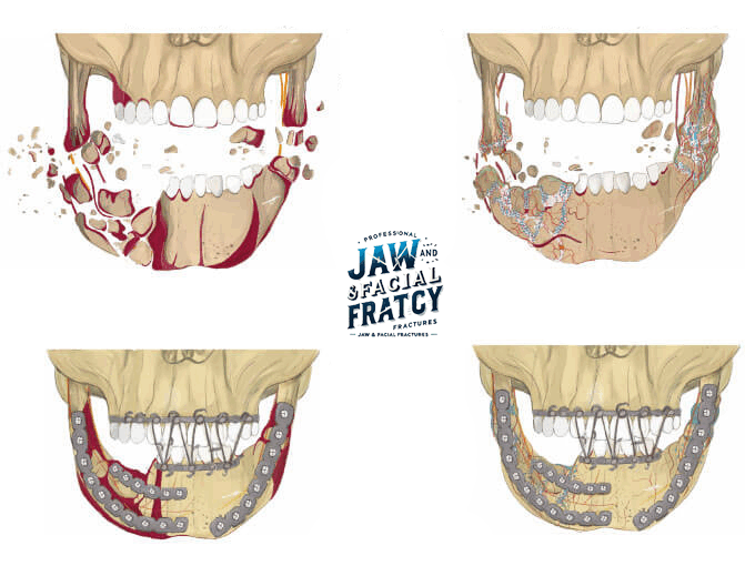 تفاوت شکستگی فک بالا و فک پایین