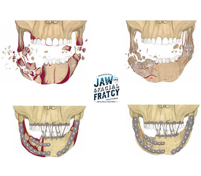 تفاوت شکستگی فک بالا و فک پایین