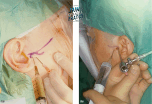 جراحی اندوسکوپیک شکستگی فک