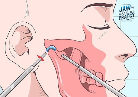 جراحی اندوسکوپیک مفصل فک