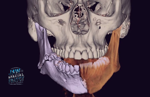 درمان شکستگی فک به روش دیجیتال