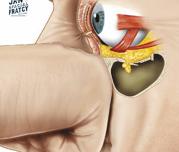 شکستگی فورانی چشم