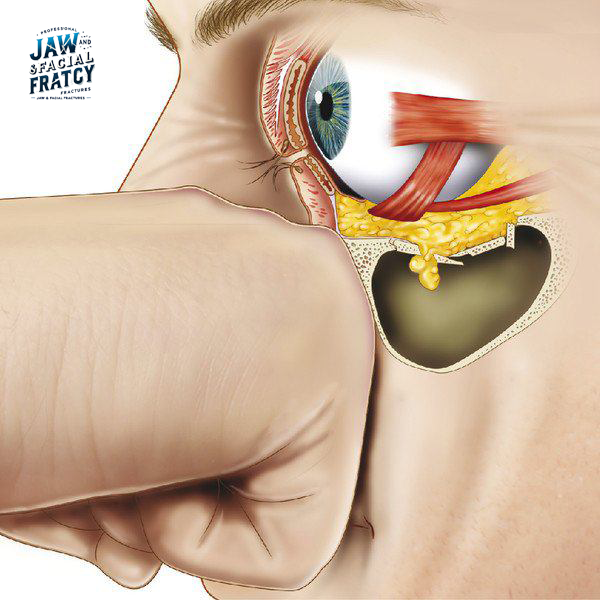 شکستگی فورانی چشم