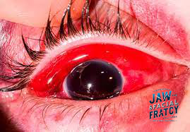 شکستگی فورانی چشم