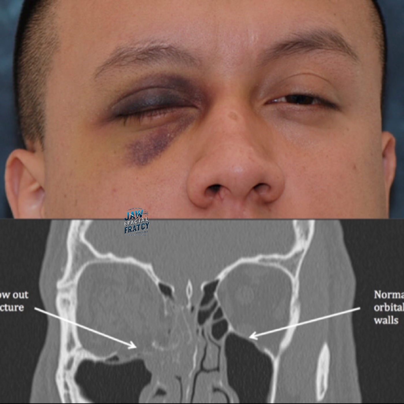 شکستگی لبه اربیت چشم