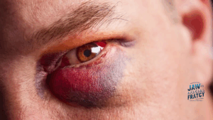 شکستگی کاسه چشم