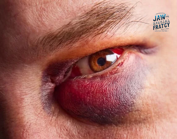 شکستگی کف اربیت چشم