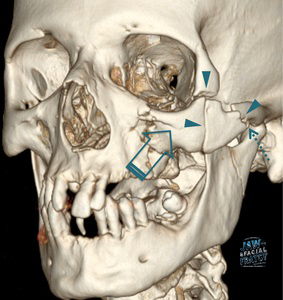 شکستگی گونه