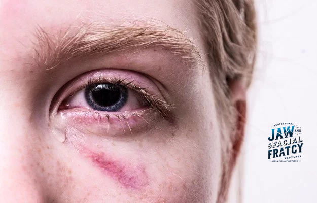 علائم شکستگی کاسه چشم