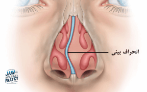 انحراف بینی