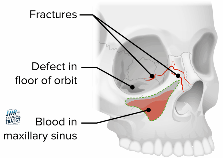 Indirect-Orbital-Floor-Fracture