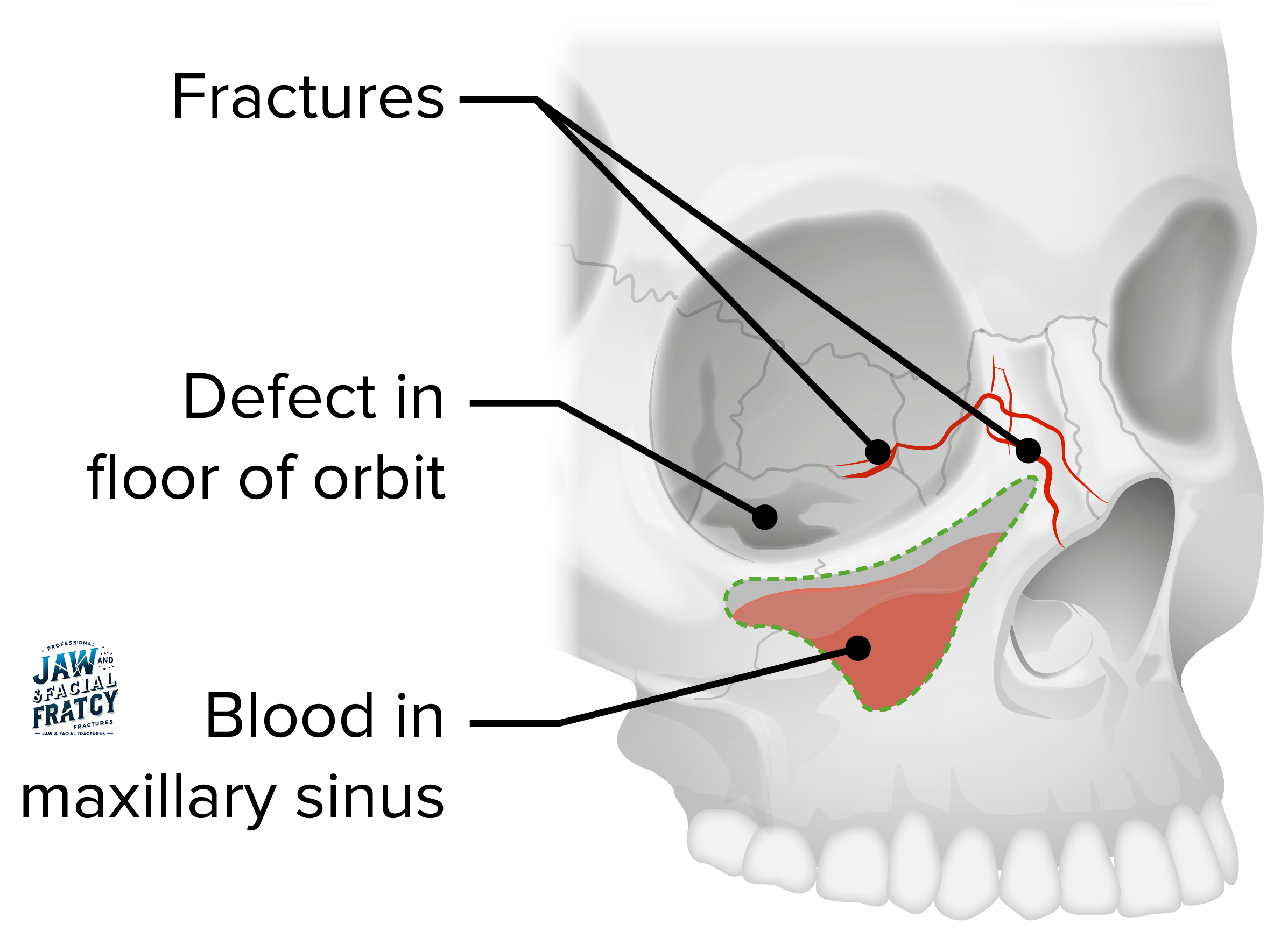 Indirect-Orbital-Floor-Fracture