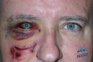 بهبود شکستگی کاسه چشم