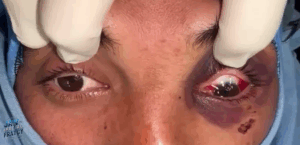 درمان شکستگی کاسه چشم