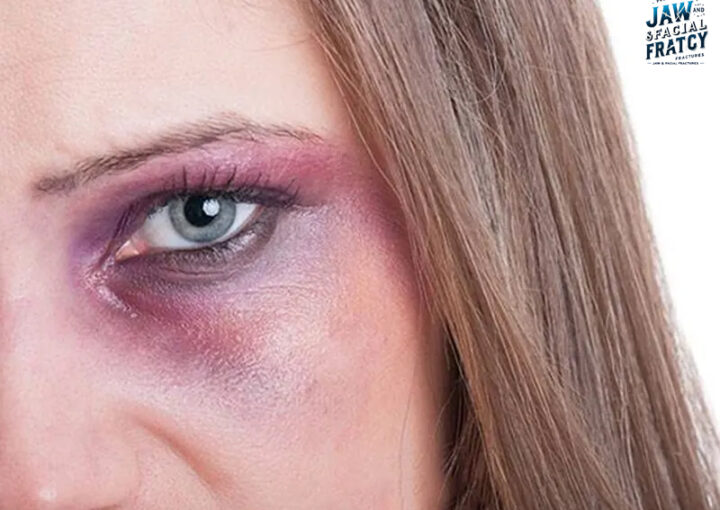 دوبینی پس از شکستگی کاسه چشم