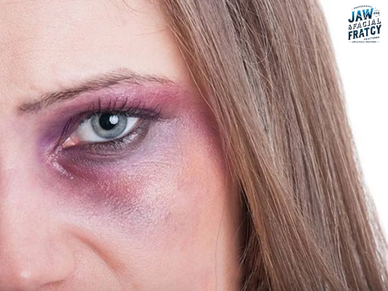 دوبینی پس از شکستگی کاسه چشم