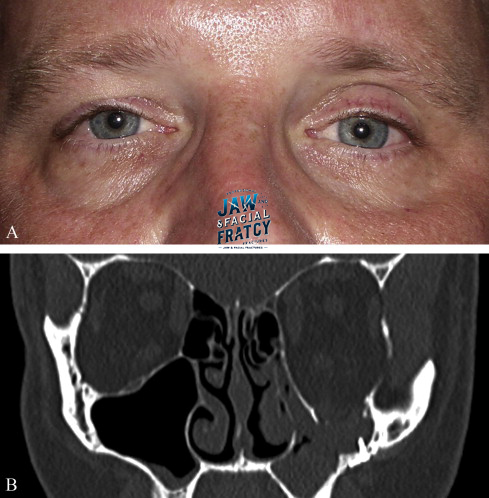 شکستگی دریچه‌ ای چشم