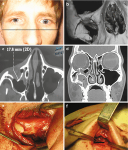 شکستگی غیرمستقیم کف اربیت چشم 