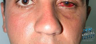 شکستگی مستقیم کف اربیت چشم