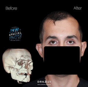 درمان شکستگی کاسه چشم تهران