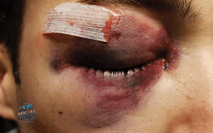 شکستگی کاسه چشم