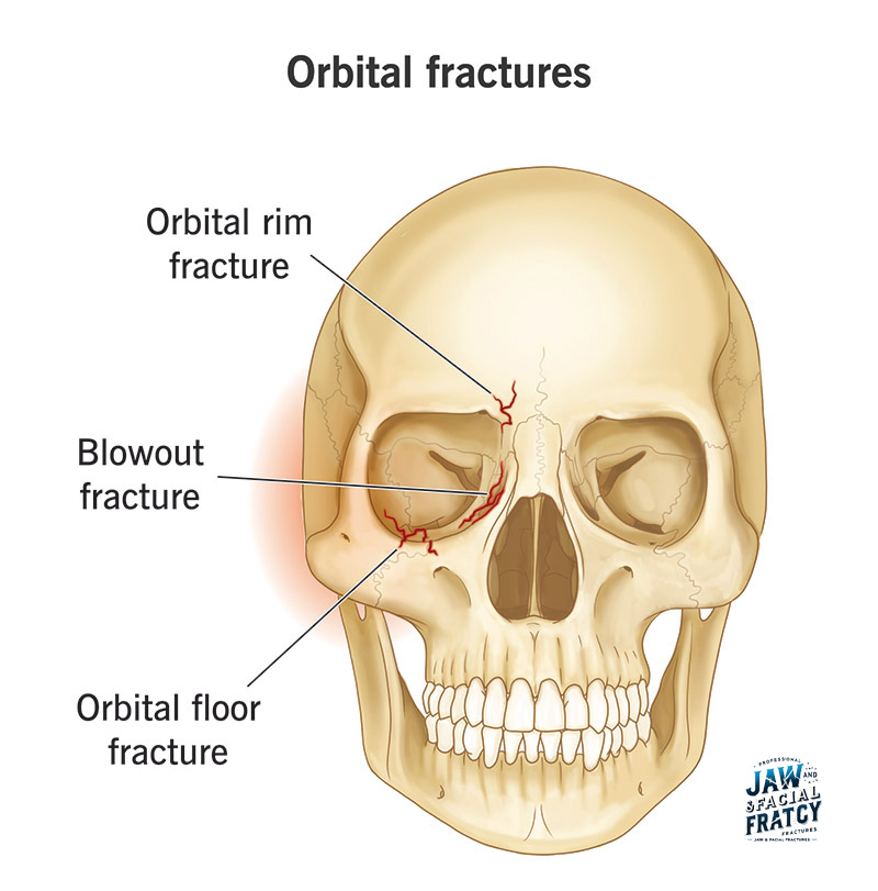 شکستگی کاسه چشم