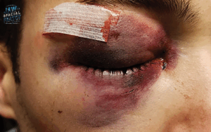 علائم شکستگی مستقیم کف اربیت چشم