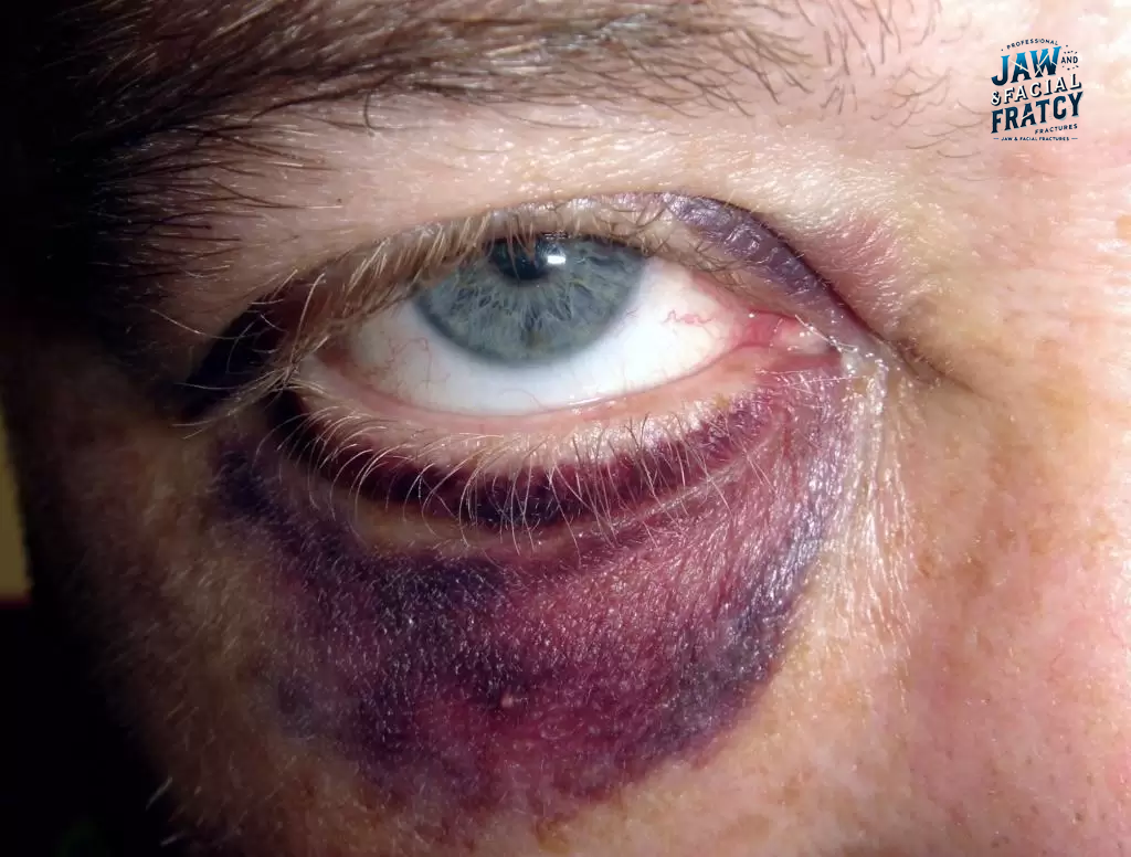 عوارض شکستگی چشم