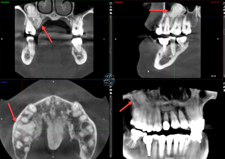 اهمیت تصویربرداری (رادیوگرافی، CT اسکن) در شکستگی فک