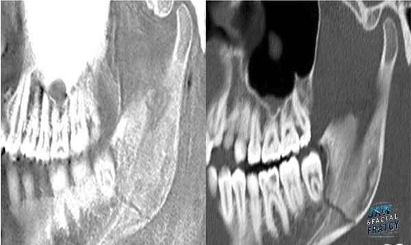 تأثیر شکستگی فک بر دندان‌ها و لثه‌ها