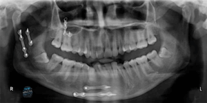 بهم ریختگی دندان ها بعد از شکستگی فک