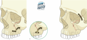 شکستگی گونه