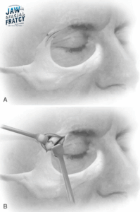 جراحی شکستگی گونه