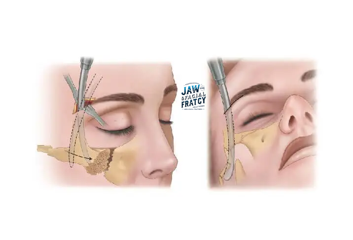 درمان شکستگی گونه