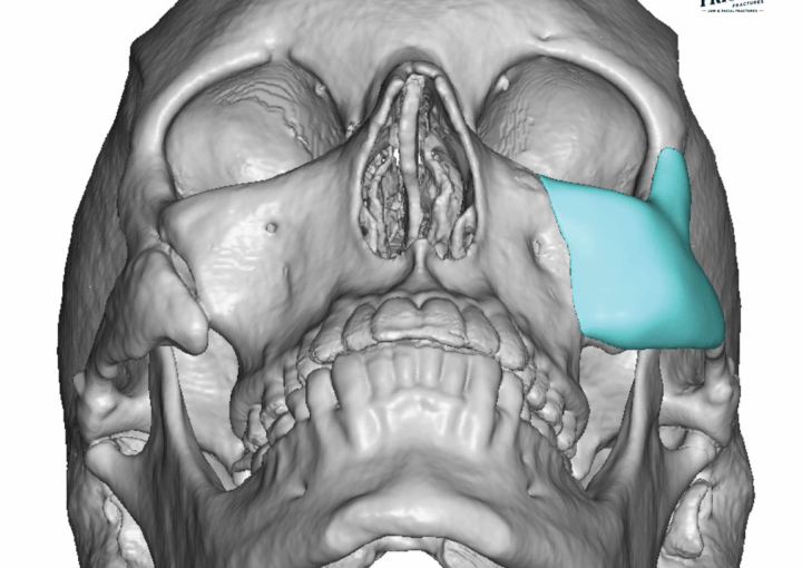 Recovery-period-after-cheek-fracture-surgery