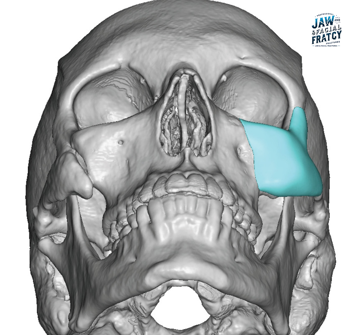 Recovery-period-after-cheek-fracture-surgery