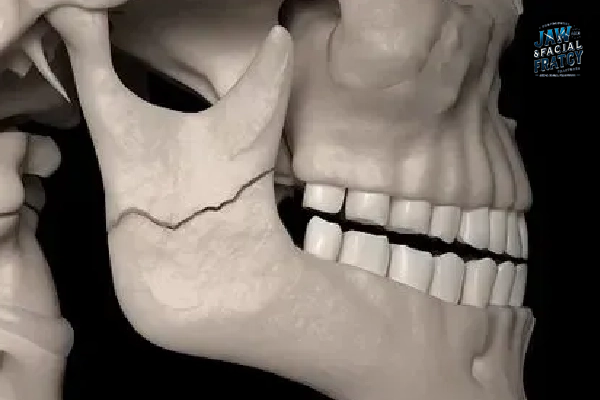 شکستگی فک پایین