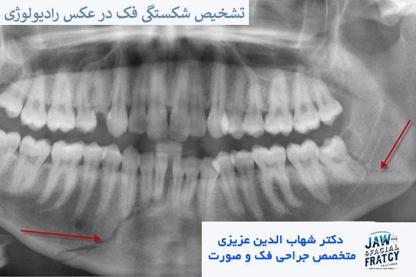 تشخیص شکستگی فک