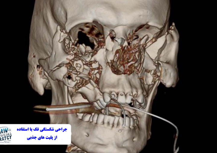 جراحی شکستگی فک با استفاده از پلیت های جذبی